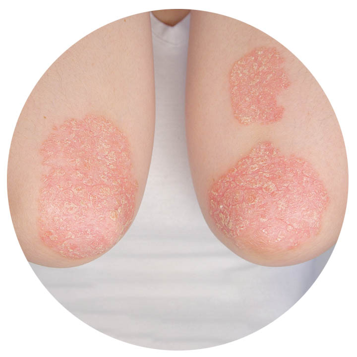 med-Psoriasis