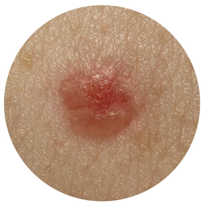 skin-cancer-BCC