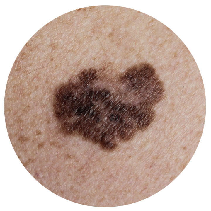 skin-cancer-MM