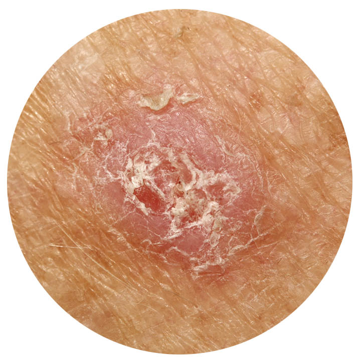 skin-cancer-SCC