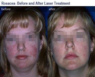 rosacea-beforeafter