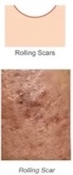 ICE PICK SCARS